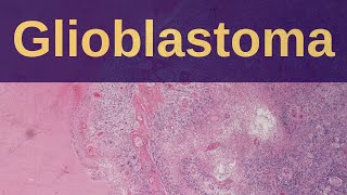 What is a Glioblastoma  Pathology mini tutorial [upl. by Asirap]