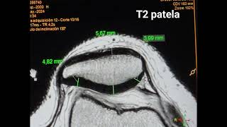 CASO RESONANCIA MAGNETICA DE RODILLA ‐ Hecho con Clipchamp [upl. by Porcia]