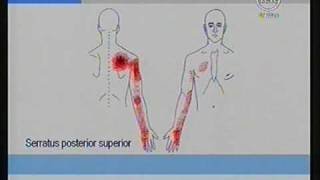 Dolores de los brazos originados por Nódulos Dolorosos Trigger Points  Dr Isaac Jakter [upl. by Kailey]