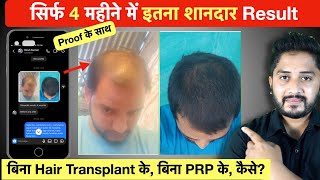 Hair Regrowth Result in 4 Months बिना Hair Transplant के। [upl. by Kudva]