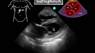 POCUS Cardiac Subxiphoid Severely Reduced EF [upl. by Relly]