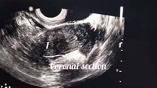 Ultrasound diagnosis of septate uterus [upl. by Soracco]