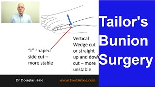 Tailors Bunion Surgery  Seattle Podiatrist [upl. by Akayas]