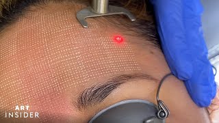 Minimize Acne Scarring With Laser Resurfacing [upl. by Inol161]