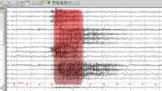 EEG in Juvenile Myoclonic Epilepsy [upl. by Eveam]