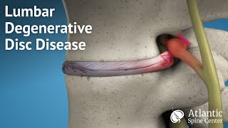 Lumbar Degenerative Disc Disease [upl. by Nyrahs]