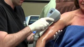 Exilis for Skin Tightening on a Womans Arms with Dr Seiler [upl. by Hedges]