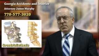 Spondylolisthesis  Back Injury Caused by Trauma from a Car Accident  Douglasville Accident Lawyer [upl. by Jennings]