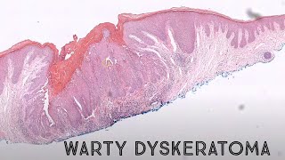 Warty Dyskeratoma acantholytic dyskeratosis pathology dermpath dermatology dermatopathology [upl. by Tikna41]