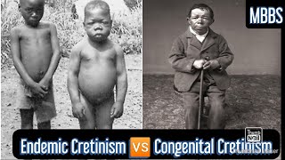 Endemic Cretinism 🆚 Congenital Cretinism  MBBS NEXT NEETPG [upl. by Normy]