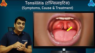 Tonsillitis  Home Remedies amp Treatment  Symptoms amp Causes of Tonsillitis By Dr Puspendra [upl. by Hotchkiss]