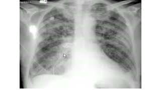 Pulmonary edema XRay review [upl. by Karlotte]