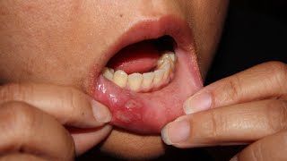 How to Get Rid of Canker Sores Home Remedies [upl. by Nauqahs445]