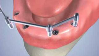 pose de 4 implants dentaires avec une barre dattachement [upl. by Neeneg]