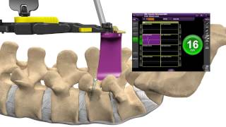 MAS® PLIF Patient Animation [upl. by Enneirb]