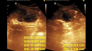 Hydro nephrosis Infant Kidney  Dilated Renal Pelvis [upl. by Brest]