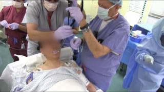 Severe Arthritic Syndrome Awake Intubation from AOD [upl. by Akinorev739]