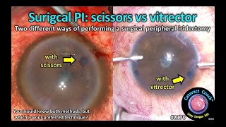 CataractCoach™ 2170 surgical peripheral iridectomy with scissors or vitrector [upl. by Ardnassela531]