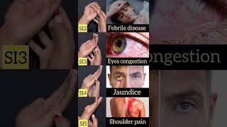 Febrile diseaseeyes congestion jaundice shoulder pain trending 2million biology shortsfeed [upl. by Edin]