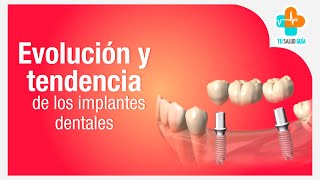 Evolución y tendencia de los implantes dentales  Tu Salud Guía [upl. by Edniya414]