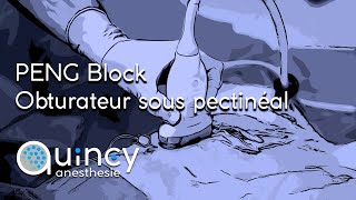 Peng Block et Bloc du nerf obturateur par voie sous pectinéale [upl. by Starla623]