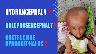 Clinical Picture Hydrancephaly Holoprosencephaly  Obstructive Hydrocephalus [upl. by Tansey]