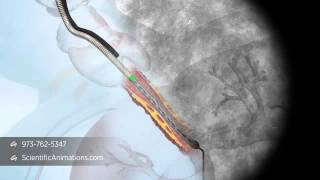 3D Medical Animation of Tracheal Stent Procedure [upl. by Llenyar]