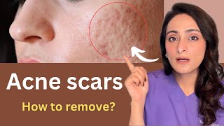 How to reduce Acne Scar  Chemical peels Dermaroller Lasers  Cost  Dermatologist Dr Aanchal [upl. by Wakefield499]