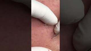 Acne extraction at Ga Spa Clinic gaspa acne phongkhamdalieu shortsvideo [upl. by Neemsaj]