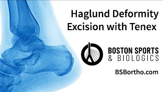 Haglund Deformity Surgery with Tenex [upl. by Suollecram]