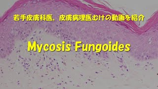 Mycosis fungoides解説動画 [upl. by Jecon]