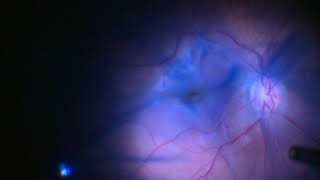 Surgery Removal of Epiretinal Membrane and ILM Dr Manish Nagpal [upl. by Henryk200]