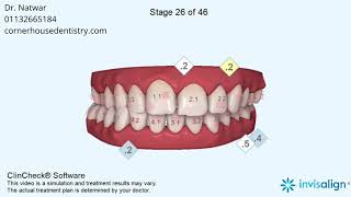 Posterior crossbite Narrow arches Asymmetric arches Mandibular midline deviation Midline shift [upl. by Eelam]