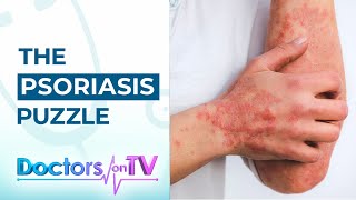 Psoriasis Know the Symptoms Causes and available Treatments from Dermatology Specialist [upl. by Durarte]