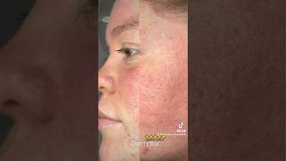 Traitement rosacée DERMALUX dermalux rosacea beauty skincare ledtherapy beauty [upl. by Freiman107]