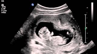 Jumping womb dancer baby ultrasound scan [upl. by Naed]