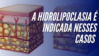 A hidrolipoclasia é indicada nesses casos [upl. by Doyle]