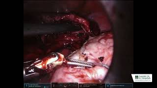 Robotic assited myomectomy [upl. by Reba]