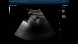 Cleft lip and palate ultrasound [upl. by Elnukeda]