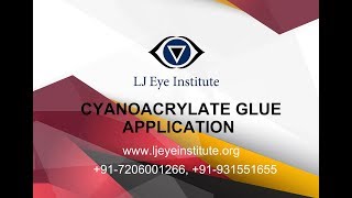 Cyanoacrylate Glue Application [upl. by Akli]