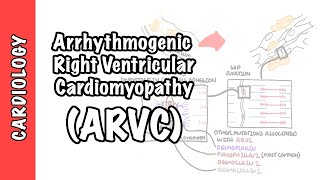 Arrhythmogenic right ventricular cardiomyopathy ARVC  pathophysiology investigations treatment [upl. by Mariam]