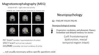 Periventricular Nodular Heterotopia with Samden Lhatoo MD and Nitin Tandon MD [upl. by Namilus]