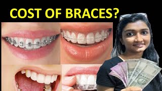 COST OF BRACES IN INDIA Dental bracesceramic bracesmetal bracesclear alignerslingual braces [upl. by Gertie]