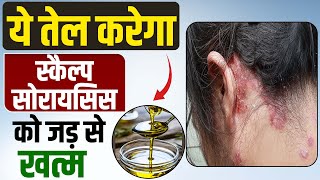 Scalp Psoriasis Removal Home Remedies  खोपड़ी सोरायसिस के घरेलू उपाय  Scalp Psoriasis Ka Ilaj [upl. by Haimorej162]