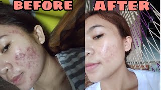 Paano nawala ang pimple ko  How I cleared my severe acne  Cystic acne [upl. by Atsahc]