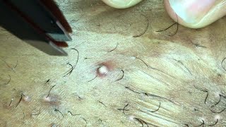 INFECTED INGROWN HAIR 05 [upl. by Ticon621]