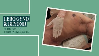 GYNECOMASTIA POST OP LEBO GYNO amp BEYOND HOUSTON MALE 30 48 HR POST FROM quotNECK 2 NUTSquot LIPOSUCTION [upl. by Aknayirp]