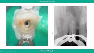 Cbct as an aid to locate calcified canals [upl. by Prager742]