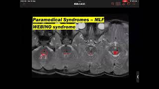 SNN MS infocus Pontine MS syndromes [upl. by Ambrosine]