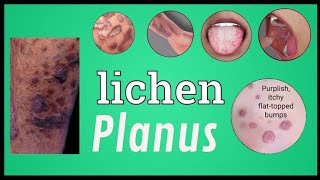 Lichen Planus TreatmentLichen Homeopathiccauses  symptoms  diagnose pathological explain hindi [upl. by Nuyh27]